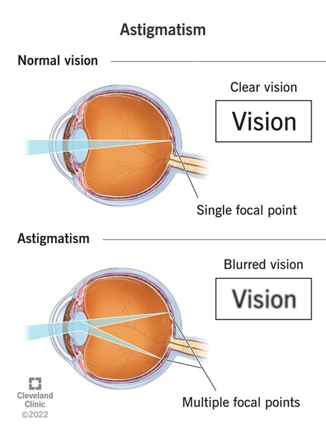 Astigmatism: Symptoms, Tests & Treatment