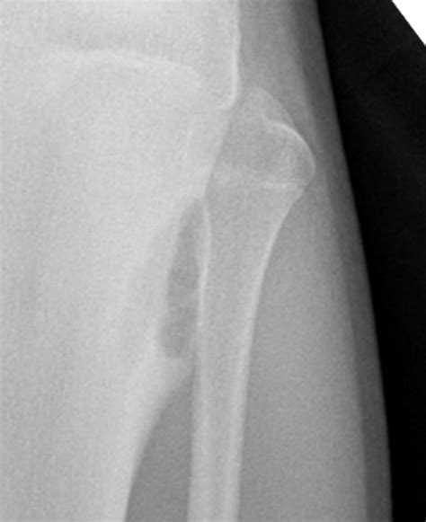 Osteoblastoma | Radiology Case | Radshare.net