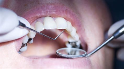 New Tooth Decay Treatment Guideline Released by ADA - Oral Health Group