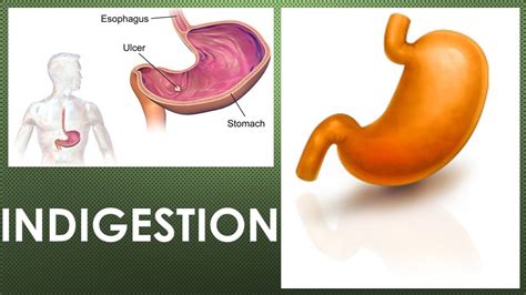 Indigestion - Symptoms And Causes