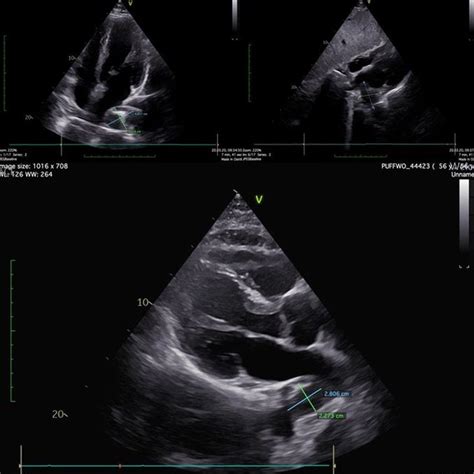 TTE findings in different views where the tumour was detected and ...