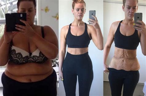 Woman shamed for 194-pound weight loss shows off body after skin ...