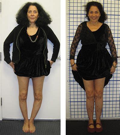 Before & After Photos - Limb Lengthening | Bow legged, Knock knees ...