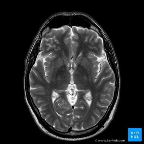 Brain MRI: How to read MRI brain scan | Kenhub