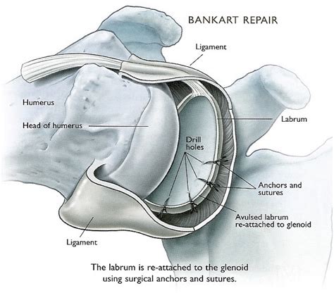 Bankart Repair Treatments | Las Vegas, Lake Havasu, Bullhead City, Nevada