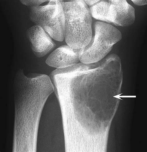 Giant Cell Tumor of Bone - OrthoInfo - AAOS