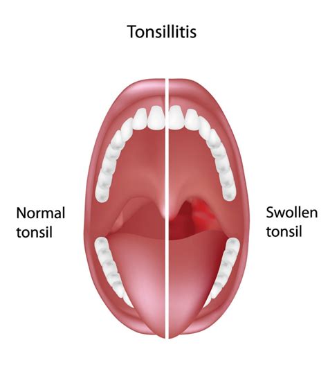 tonsillitis - Pediatric Pulmonologists