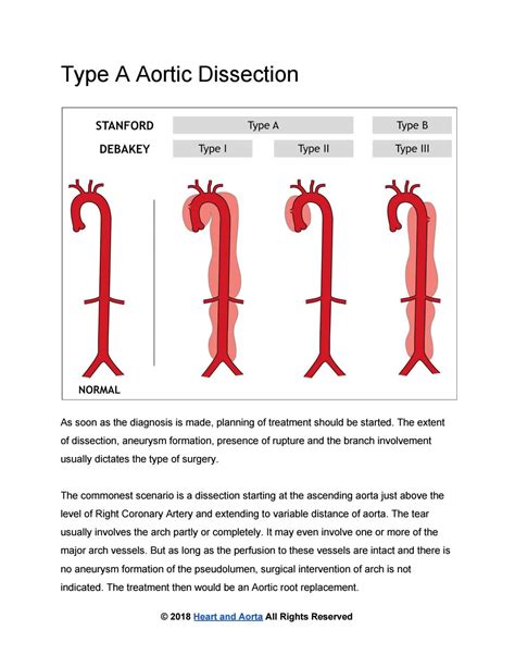 ﻿Type A Aortic Dissection by Heart and Aorta - Issuu