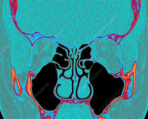 Sinuses On Ct Scan