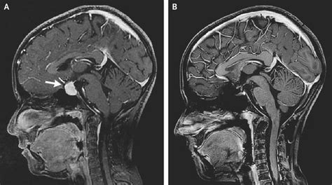 Pituitary Hyperplasia from Primary Hypothyroidism - MEDizzy