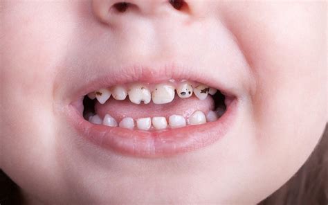 Baby Bottle Tooth Decay: Causes, Symptoms and Prevention