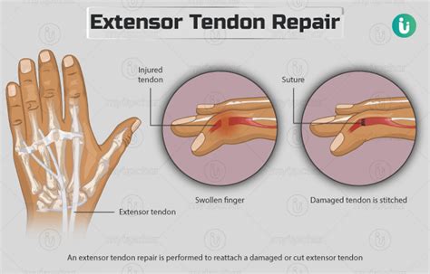 Extensor Tendon Repair: Procedure, Purpose, Results, Cost, Price ...