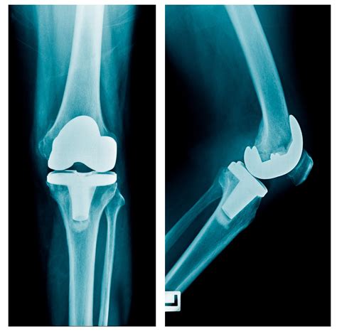 Total Knee Replacement (TKR) | Dr A. Theodorides Knee Surgeon Specialist