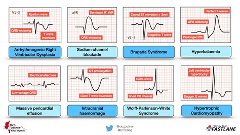 What Can Cause Abnormal Ecg Results - Printable Templates Protal