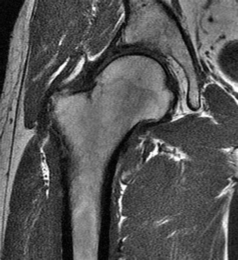 Postoperative Hip MRI in Patients Treated for FAI | Radsource