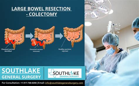 Large Bowel Resection (Colectomy) Procedure - Southlake General Surgery