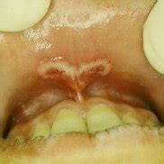 Clinical features of the “mucous patches” form. Serpiginous lesions ...