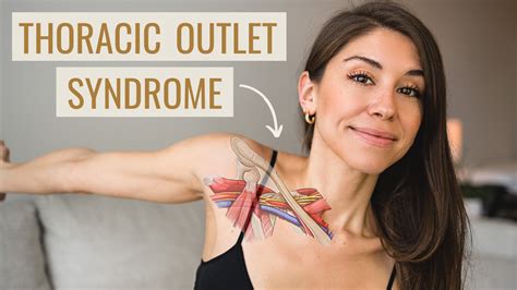 Thoracic Outlet Syndrome Exercises (HOW TO FIX IT!). Causes, Symptoms ...