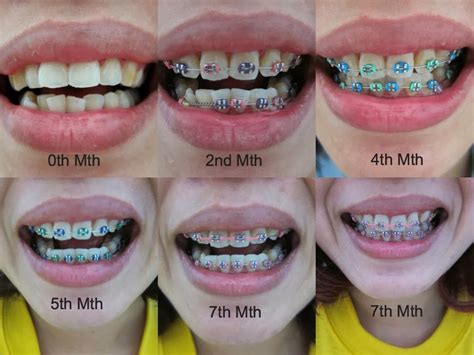 32+ Best Braces Colors For Girls Background