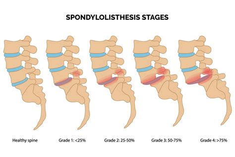 Spondylolisthesis: Diagnosis & Treatment | Aptiva Health