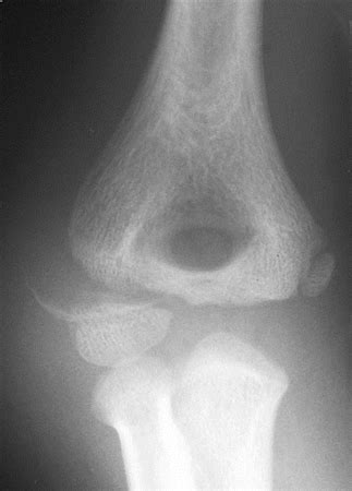 Lateral Condyle Fracture - Pediatric - Pediatrics - Orthobullets