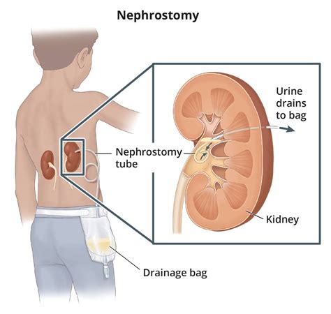 Ostomy Surgery: Ileostomy & Colostomy | UCSF Department of Surgery