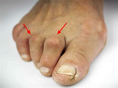 Hammer toe causes, appearance, symptoms and hammer toe treatment