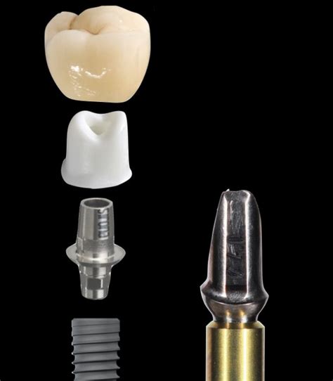 The 2-Piece Custom Implant Abutment - Spear Education