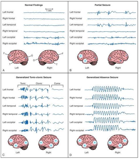 Pattern on EEG Fig.2 Patterns on electroencephalogram (EEG) in the ...