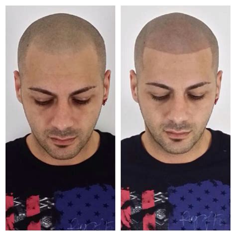 Before and after of an amazing procedure we did. We are the best in the ...