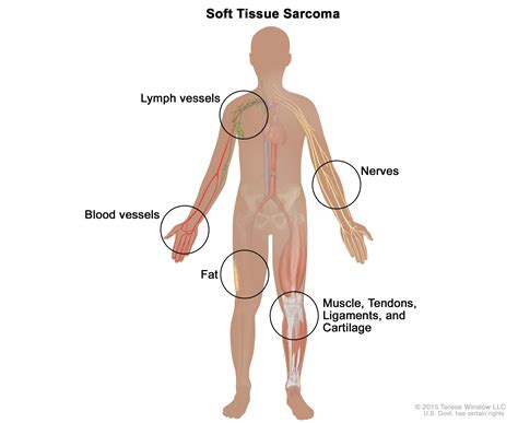 What Is Sarcoma? Types, Survival Rates | OHSU Knight Cancer Institute