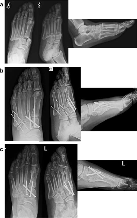 a Anteroposterior, oblique, and lateral injury radiographs of left foot ...