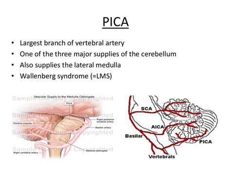 Posterior circulation stroke Syndromes