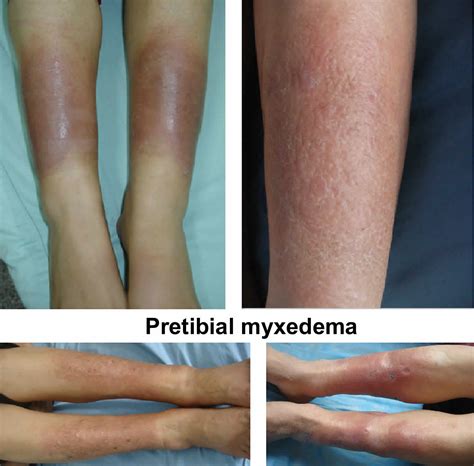 Pretibial myxedema causes, symptoms, diagnosis, treatment & prognosis