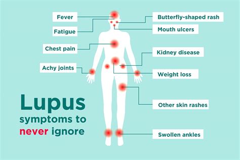 Lupus Signs and Symptoms: How to Tell If You Could Have Lupus