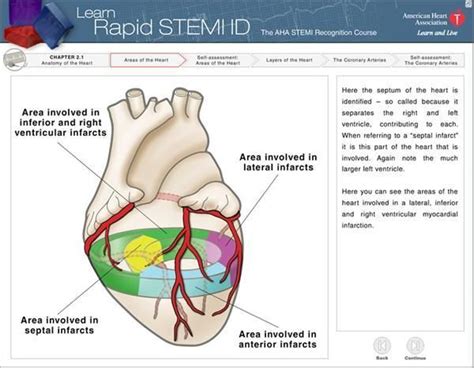 STEMI Heart Attacks: Understand the Dangers • MyHeart | Heart attack ...