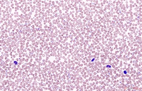 Polycythemia Vera Blood Smear