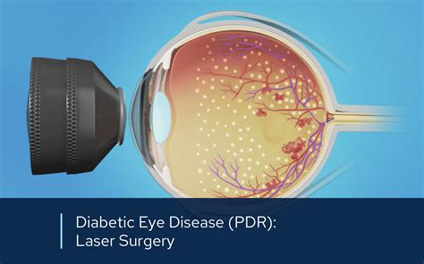 Panretinal Photocoagulation | Retinal Consultants Medical Group