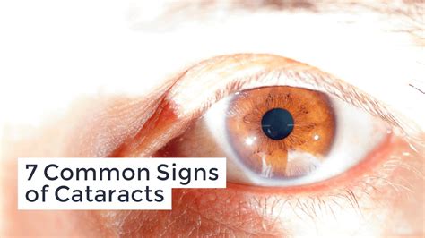 Does cataract surgery cause halos Info | Best Home Design