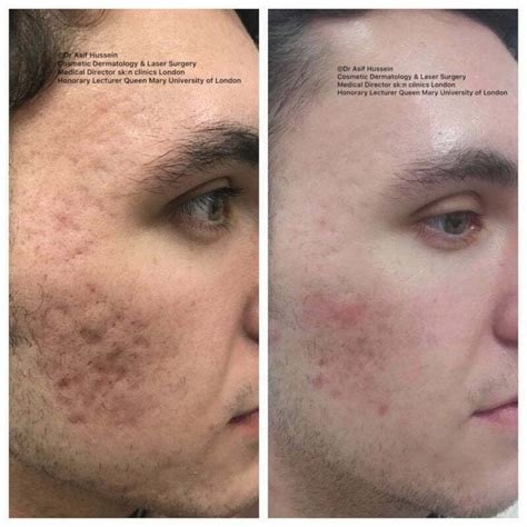 Acne Scar Laser Treatment & Removal London | Dr H Consult