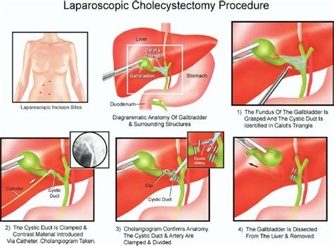 Figure 2. A laparoscopic cholecystectomy with intraoperative ...