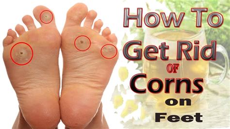 How to Get Rid of Corns on Feet Naturally at Home || Home Remedies for ...