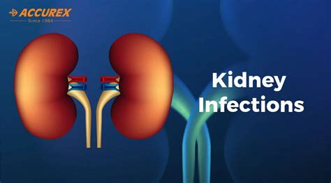 Kidney Infections | Symptoms, Causes, Diagnosis & Treatment