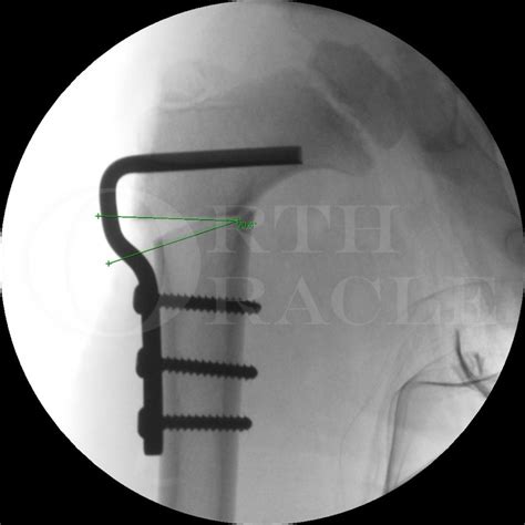 Proximal Femoral Osteotomy