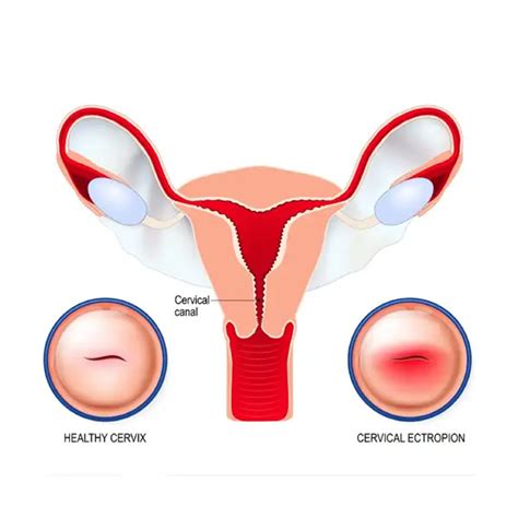 Cervical Ulcer – "Royan" Superspecialized Infertility Treatment Center