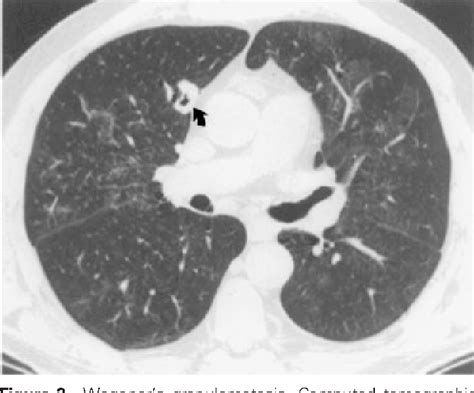 Figure 2 from Pulmonary vasculitis. | Semantic Scholar