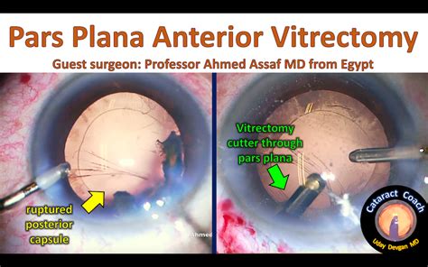 Pars Plana Anterior Vitrectomy can be very helpful – Cataract Coach