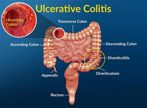 Ulcerative Colitis Treatment in Vadodara by Dr. Chairyu Chokshi