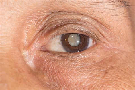 Cataracts | Palmetto Eye | Local Optometrist in Rock Hill, SC