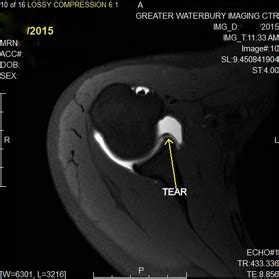 MR Arthrogram case study of the right shoulder | GWIC